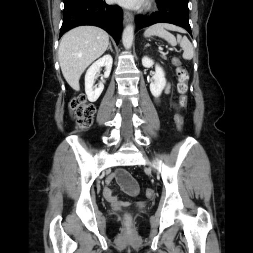 Closed loop small bowel obstruction due to adhesive bands - early and late images (Radiopaedia 83830-99015 B 80).jpg
