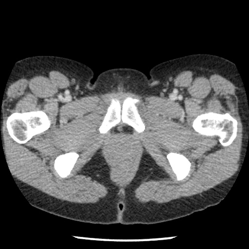 File:Closed loop small bowel obstruction due to trans-omental herniation (Radiopaedia 35593-37109 A 89).jpg