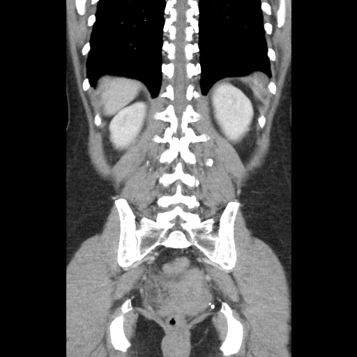 File:Closed loop small bowel obstruction due to trans-omental herniation (Radiopaedia 35593-37109 B 41).jpg
