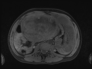 Closed loop small bowel obstruction in pregnancy (MRI) (Radiopaedia 87637-104031 Axial T1 fat sat 69).jpg