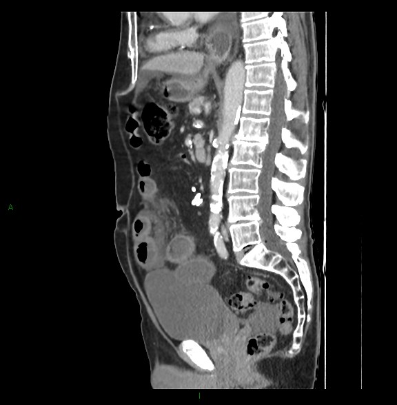 Closed loop small bowel obstruction with ischemia (Radiopaedia 84180-99456 C 48).jpg