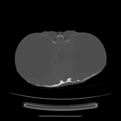 Cloverleaf skull (Radiopaedia 91901-109710 Axial bone window 78).jpg