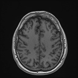 File:Cochlear incomplete partition type III associated with hypothalamic hamartoma (Radiopaedia 88756-105498 Axial T1 137).jpg