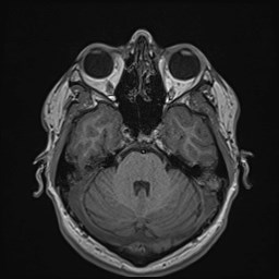 Cochlear incomplete partition type III associated with hypothalamic hamartoma (Radiopaedia 88756-105498 Axial T1 68).jpg