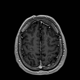 Cochlear incomplete partition type III associated with hypothalamic hamartoma (Radiopaedia 88756-105498 Axial T1 C+ 156).jpg