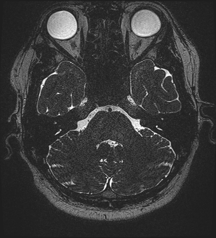 Cochlear incomplete partition type III associated with hypothalamic hamartoma (Radiopaedia 88756-105498 Axial T2 81).jpg