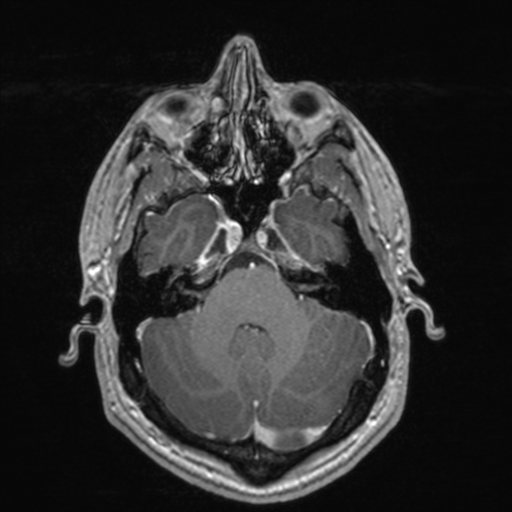 File:Colloid cyst (Radiopaedia 44510-48181 Axial T1 C+ 56).png