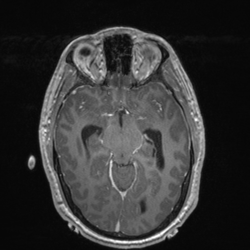 File:Colloid cyst (Radiopaedia 44510-48181 Axial T1 C+ 78).png