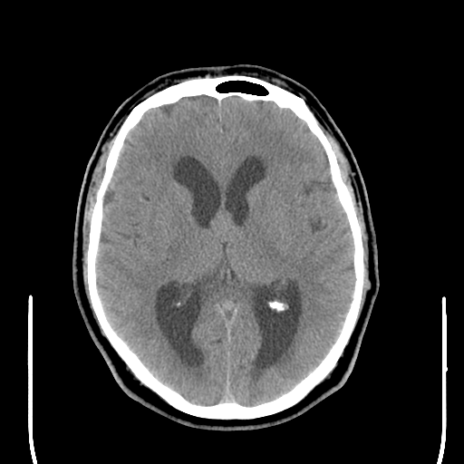 File:Colloid cyst (large) (Radiopaedia 34415-35734 Axial non-contrast 30).png
