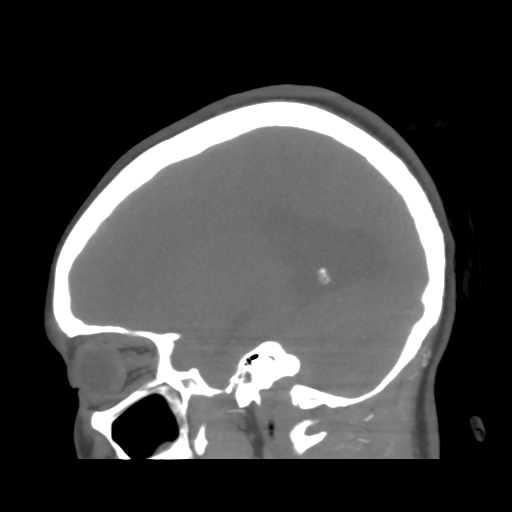 File:Colloid cyst (resulting in death) (Radiopaedia 33423-34499 B 39).png