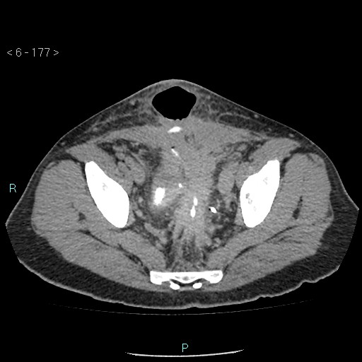 File:Colo-cutaneous fistula (Radiopaedia 40531-43129 A 74).jpg