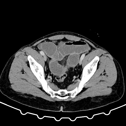 Colocolic intussusception due to large lipoma (Radiopaedia 68773-78482 A 164).jpg