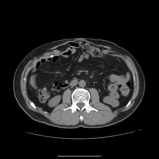 File:Colocutaneous fistula in Crohn's disease (Radiopaedia 29586-30093 Axial non-contrast 2).jpg