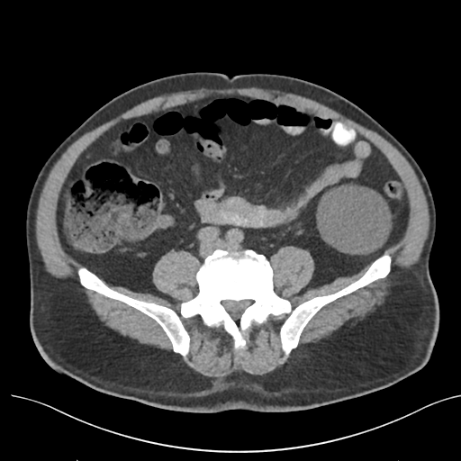 File:Colon adenocarcinoma - splenic flexure (Radiopaedia 34143-35406 Axial Oral contrast 59).png