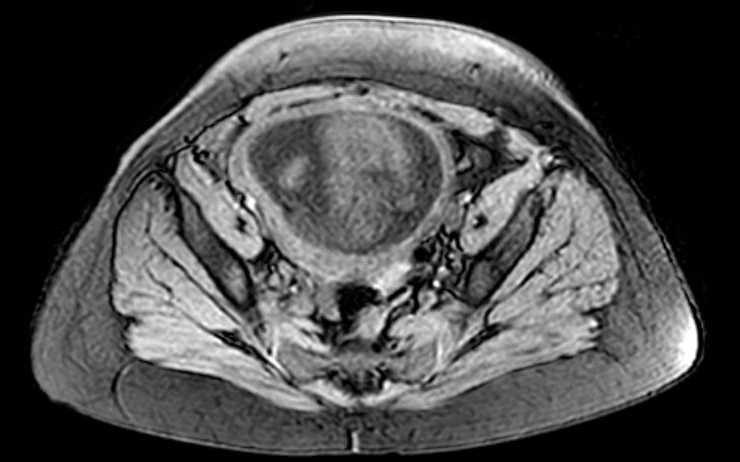 Colon adenocarcinoma with Krukenberg tumors, advanced pregnancy (Radiopaedia 67279-76645 A 20).jpg
