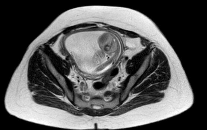 File:Colon adenocarcinoma with Krukenberg tumors, advanced pregnancy (Radiopaedia 67279-76645 Axial T2 18).jpg