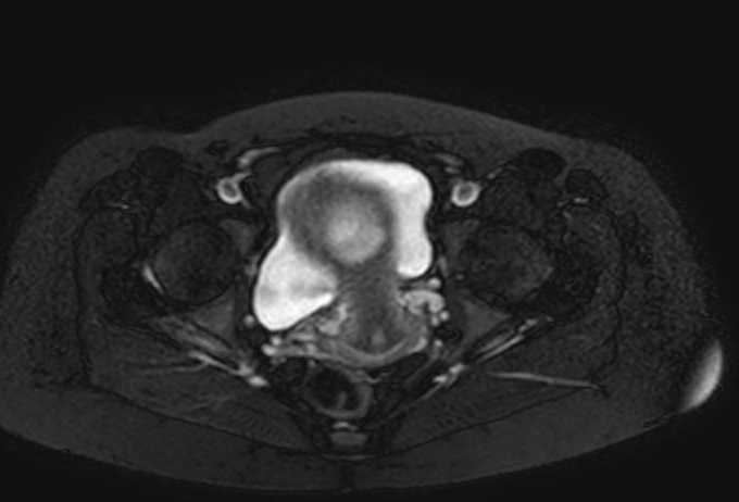File:Colon adenocarcinoma with Krukenberg tumors, advanced pregnancy (Radiopaedia 67279-76645 Axial T2 SPAIR 8).jpg