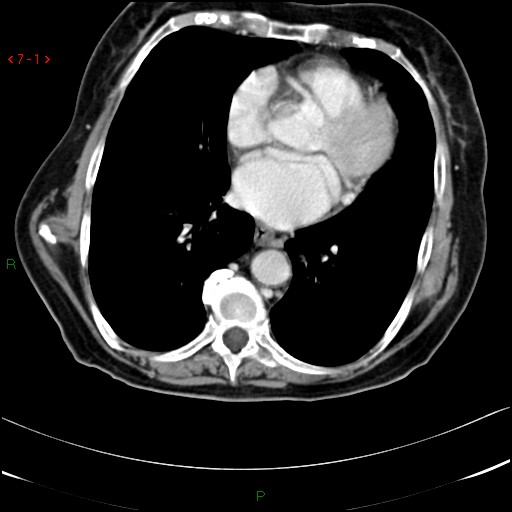 File:Colon cancer resulting in large bowel obstruction (Radiopaedia 15648).jpg