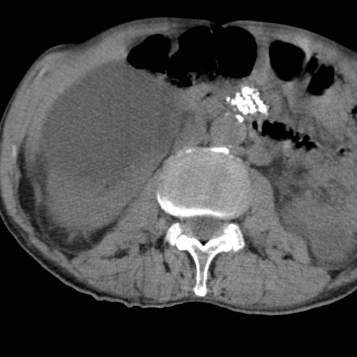 Colon cancer with calcified liver metastasis (Radiopaedia 74423-85309 Axial non-contrast 45).jpg