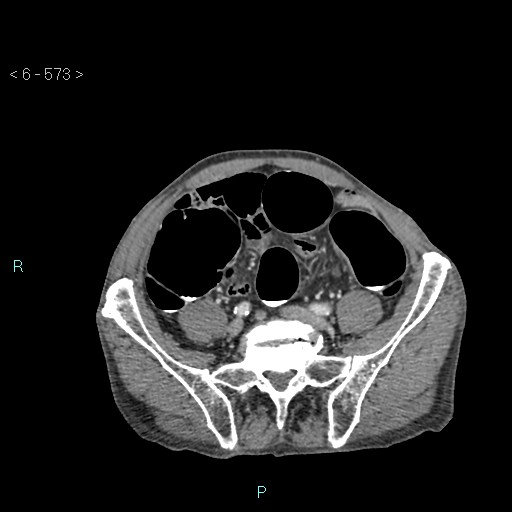 File:Colonic cancer (ultrasound and TC imaging) (Radiopaedia 50346-55713 A 91).jpg