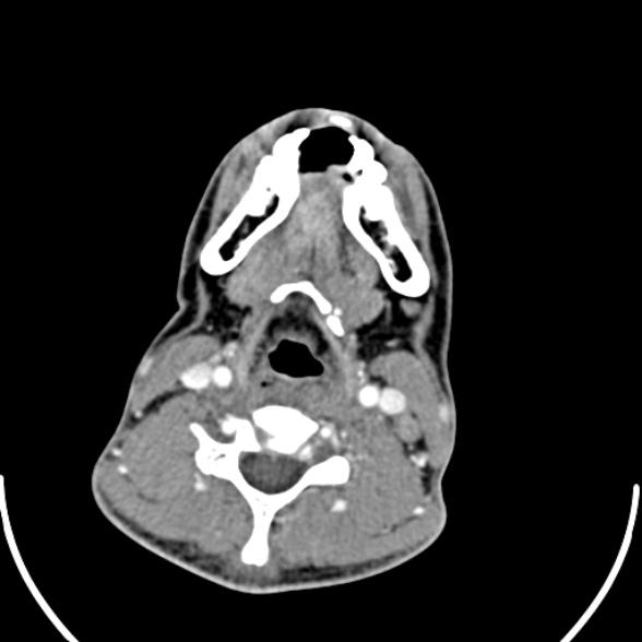 Nasopharyngeal carcinoma with skull base invasion (Radiopaedia 53415-59705 A 133).jpg