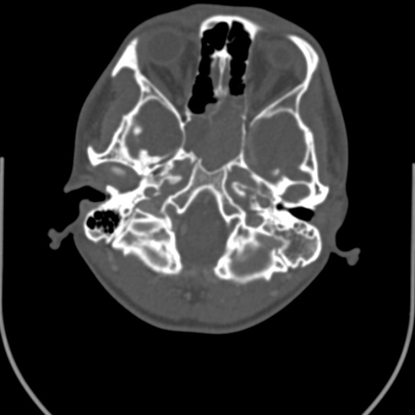 File:Nasopharyngeal carcinoma with skull base invasion (Radiopaedia 53415-59705 Axial bone window 20).jpg
