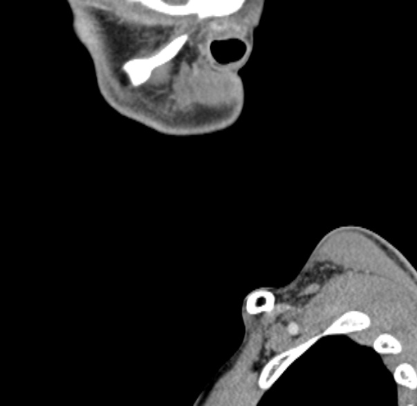 Nasopharyngeal carcinoma with skull base invasion (Radiopaedia 53415-59705 C 70).jpg