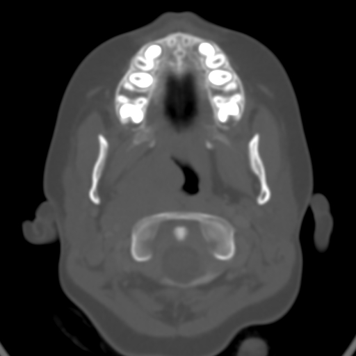 File:Nasopharyngeal rhabdomyosarcoma (Radiopaedia 23417-23491 Axial bone window 2).jpg