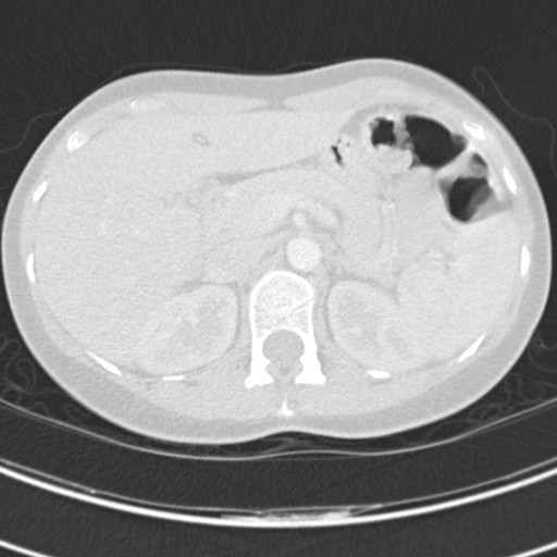 File:Necrobiotic pulmonary nodules - Crohn disease (Radiopaedia 20723-20631 Axial lung window 147).jpg