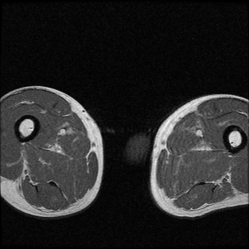 File:Necrotizing epididymo-orchitis with intra-testicular abscess (Radiopaedia 29397-29860 Axial T1 C+ 19).jpg
