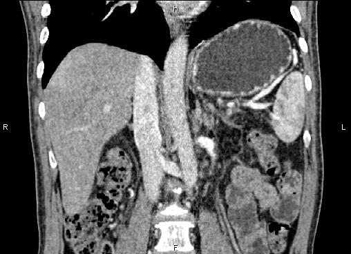 Necrotizing pancreatitis (Radiopaedia 87796-104248 F 37).jpg