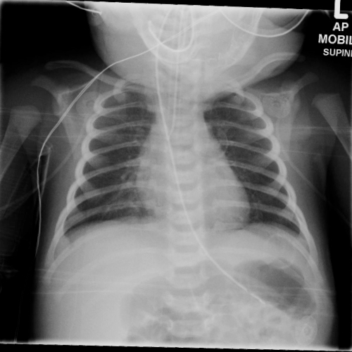 File:Neonatal pneumonia (Radiopaedia 23898-24087 Frontal 1).jpg
