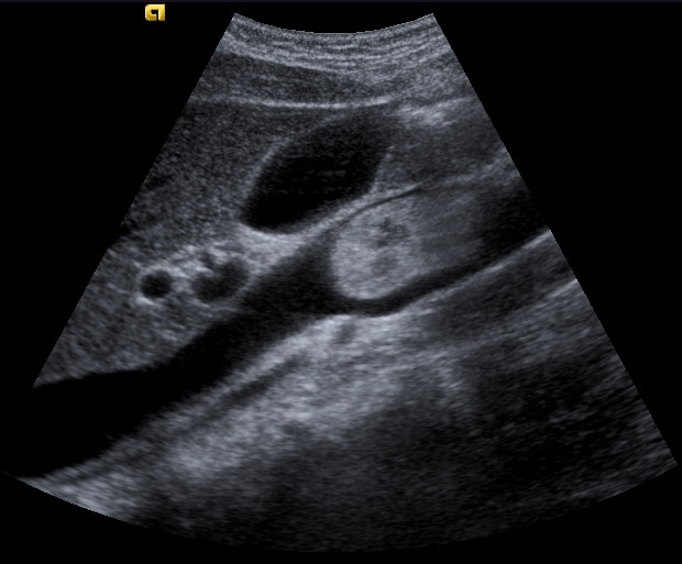 File:Neoplastic thrombosis in the inferior vena cava (Radiopaedia 30840-31554 Longitudinal 1).jpg