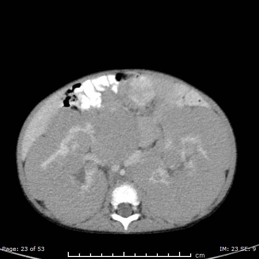 Nephroblastomatosis (Radiopaedia 41934-44935 A 23).jpg