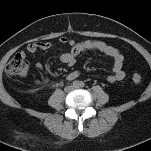 File:Nephrostomy for urosepsis (Radiopaedia 26180-26330 Axial non-contrast 37).jpg