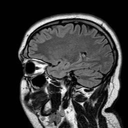 File:Neuro-Behcet's disease (Radiopaedia 21557-21506 Sagittal FLAIR 10).jpg