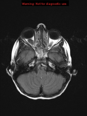 File:Neurofibromatosis type 1 with optic nerve glioma (Radiopaedia 16288-15965 Axial FLAIR 20).jpg