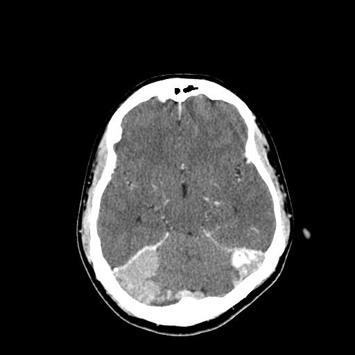 File:Neurofibromatosis type 2 (Radiopaedia 25389-25637 Axial C+ 33).jpg
