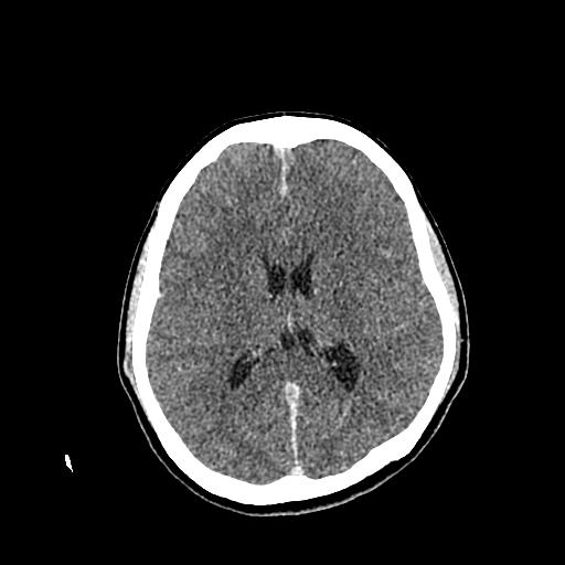 File:Neurofibromatosis type 2 (Radiopaedia 25389-25637 Axial C+ 55).jpg