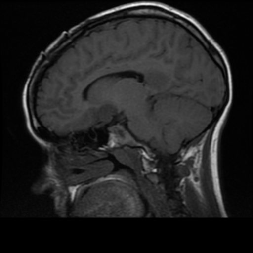 File:Neurofibromatosis type 2 (Radiopaedia 45229-49244 Sagittal T1 9).png