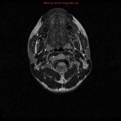 File:Neurofibromatosis type 2 (Radiopaedia 8953-9730 Axial FLAIR 1).jpg