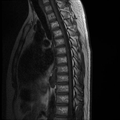 File:Neurofibromatosis type 2 (spinal manifestations) (Radiopaedia 53943-60070 D 7).png
