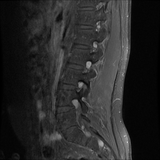 File:Neurofibromatosis type 2 (spinal manifestations) (Radiopaedia 53943-60070 K 11).png