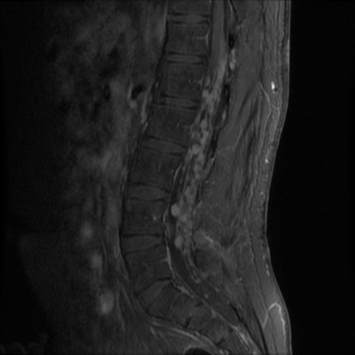 File:Neurofibromatosis type 2 (spinal manifestations) (Radiopaedia 53943-60070 K 8).png