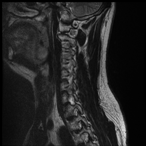 File:Neurofibromatosis type 2 (spinal manifestations) (Radiopaedia 53943-60070 Sagittal T2 10).png