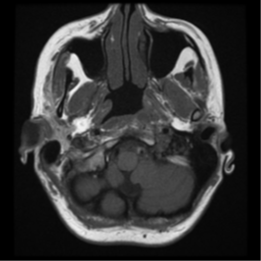 File:Neurofibromatosis type 2 - bilateral acoustic neuromata (Radiopaedia 40060-42566 Axial T1 2).png