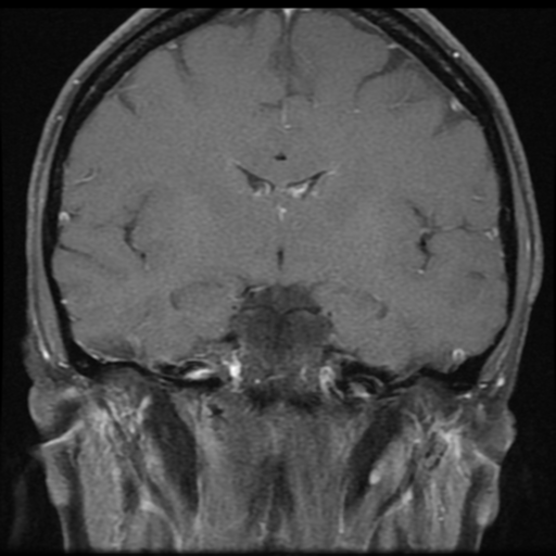 File:Neurofibromatosis type 2 - bilateral acoustic neuromata (Radiopaedia 40060-42566 Coronal T1 C+ 8).png