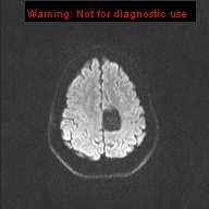 File:Neuroglial cyst (Radiopaedia 10713-11184 Axial DWI 28).jpg