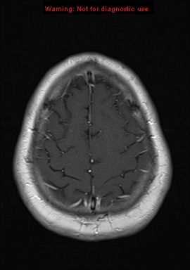 File:Neuroglial cyst (Radiopaedia 10713-11184 Axial T1 C+ 4).jpg