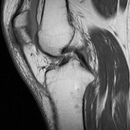 File:Non-displaced patella fracture (Radiopaedia 15932-15582 Sagittal T1 9).jpg